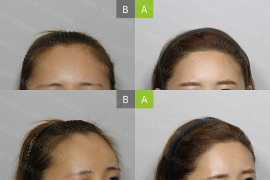 Slider image (4) MOAMAN Hair Transplant Clinic